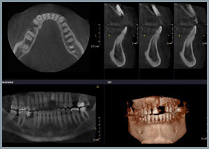 CBCT