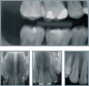 Intraoralne snimke